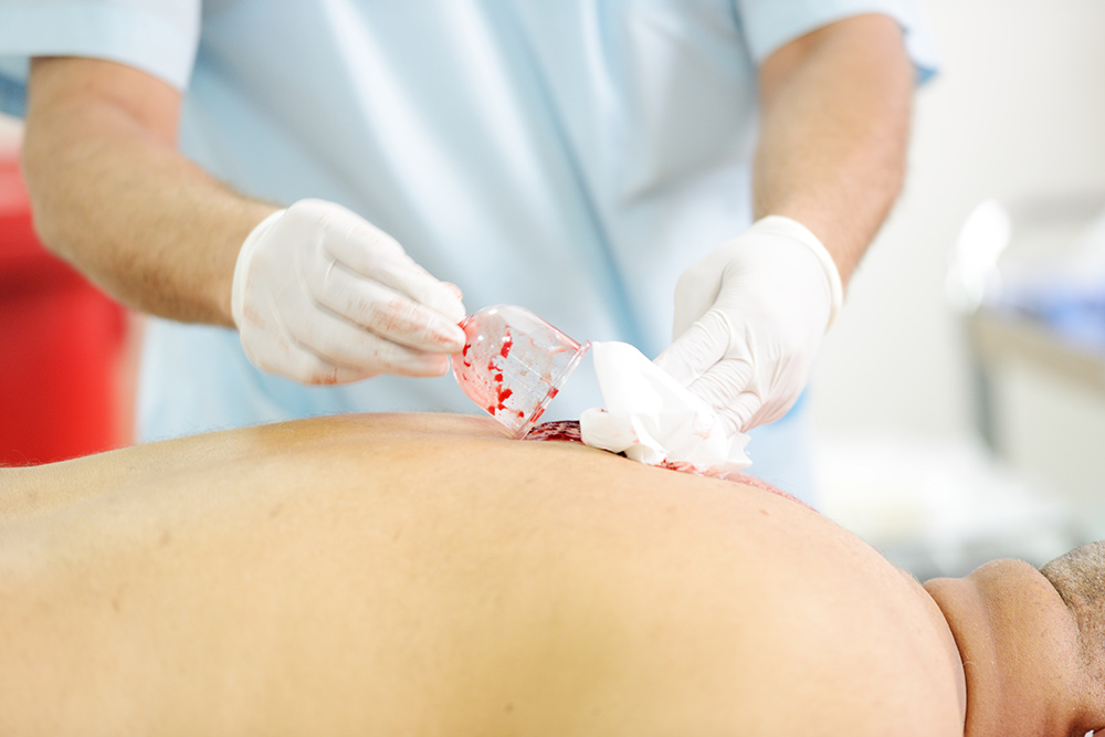 Hijama Medical therapy Sri Lanka